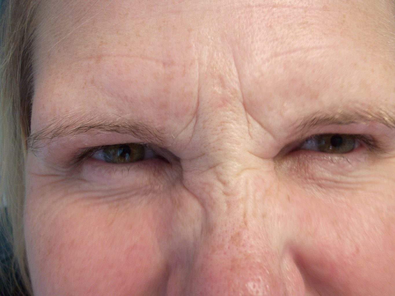 Image of pre treatment forehead treated with Dysport or Botox Paralytic