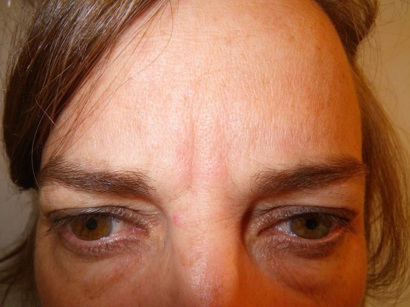 Image of post treatment forehead treated with Dysport or Botox Paralytic with excellent result