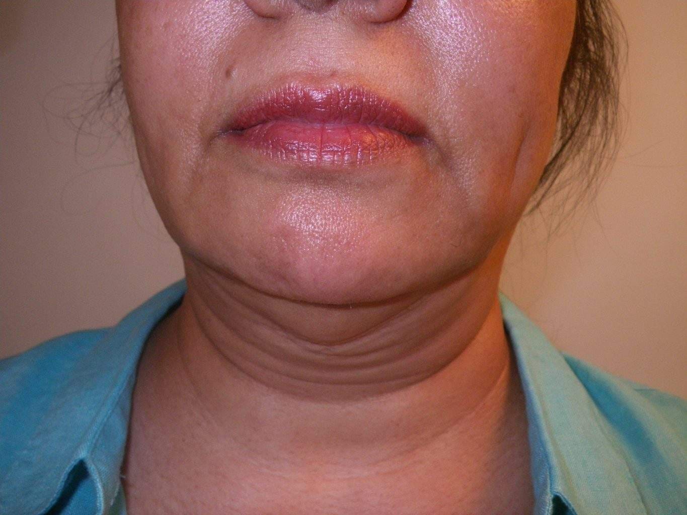 preop Image of best Smartlipo Neck Liposuction 
