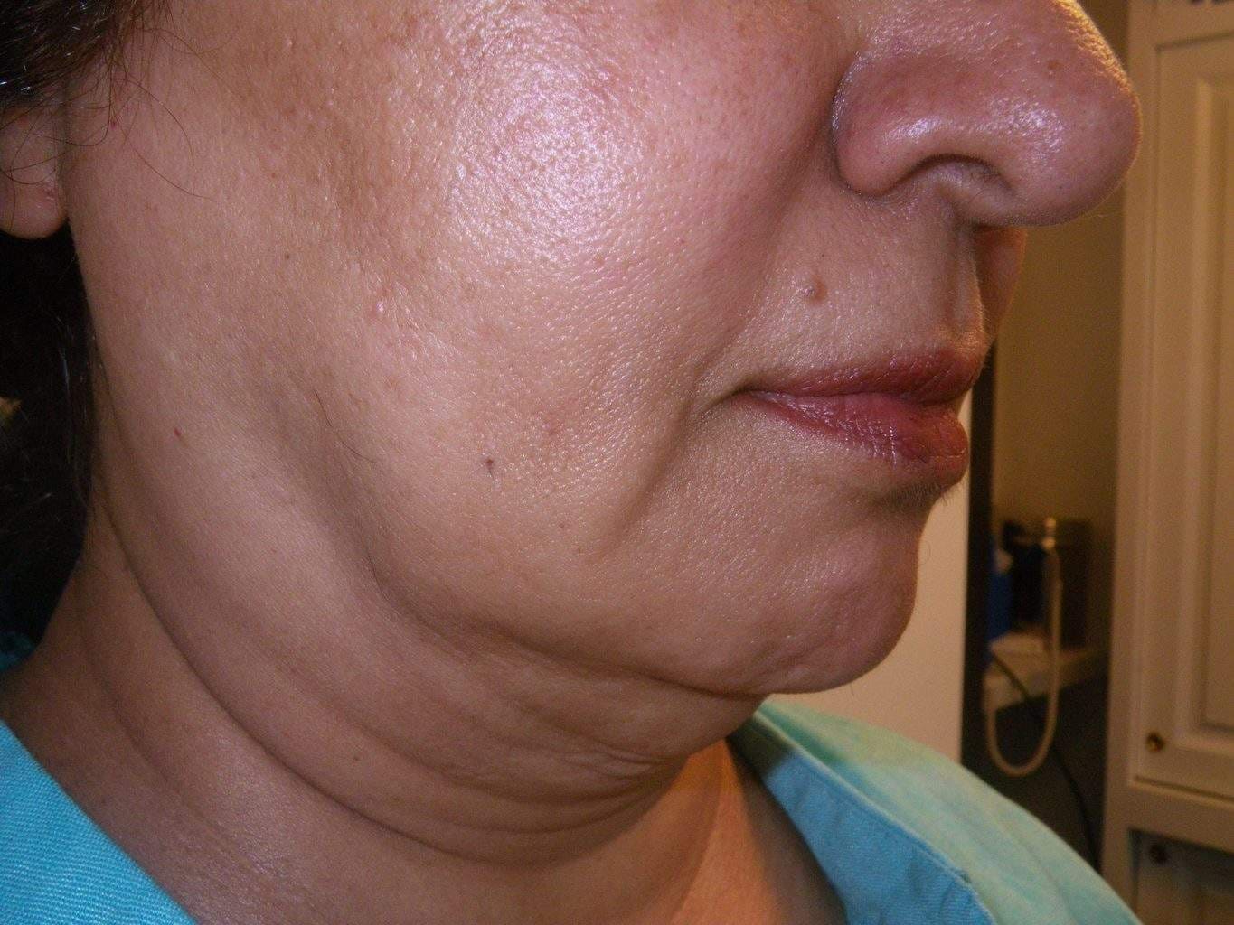 preop Image of best Smartlipo Neck Liposuction