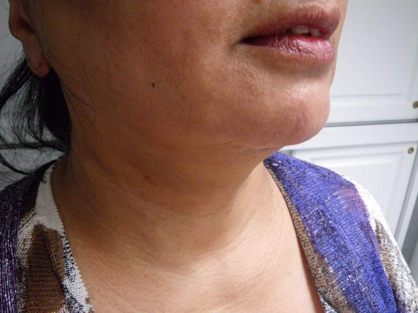 Post Op image of excellent Smartlipo Neck Liposuction