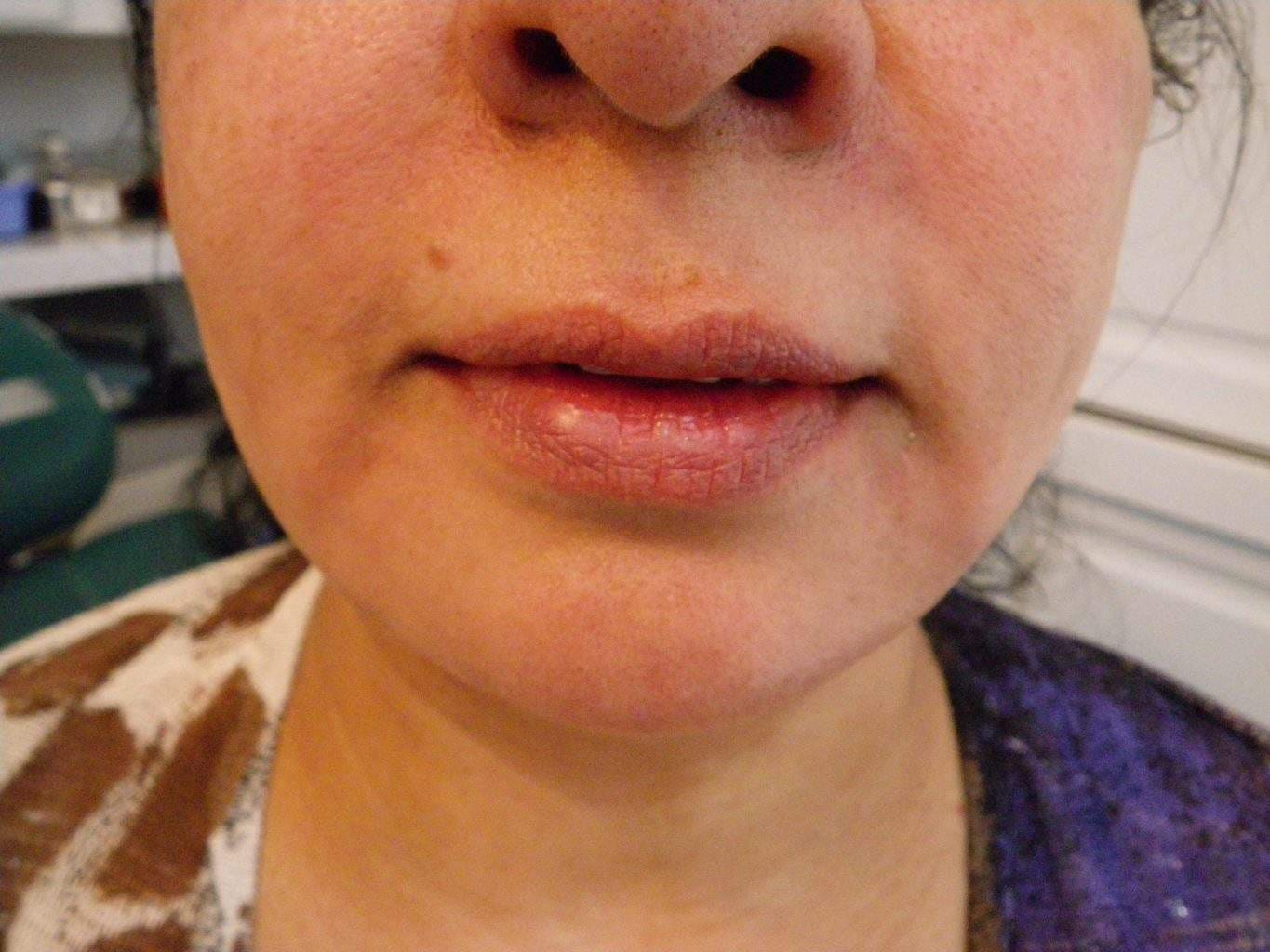 Post Op image of excellent Smartlipo Neck Liposuction