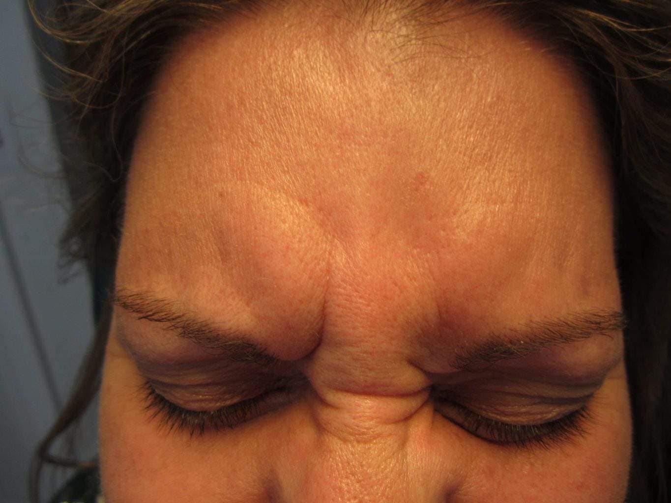 Image of pre treatment forehead treated with Dysport or Botox Paralytic
