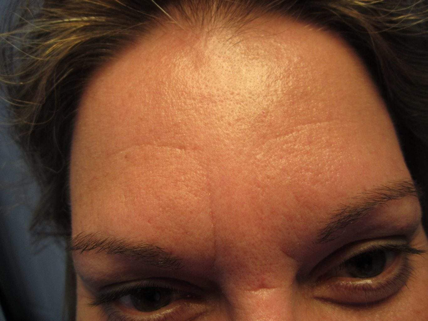 Image of post treatment forehead treated with Dysport or Botox Paralytic with excellent result