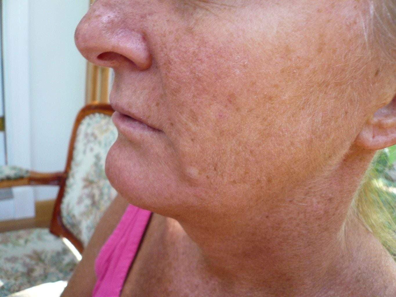 preop Image of best Smartlipo Neck Liposuction