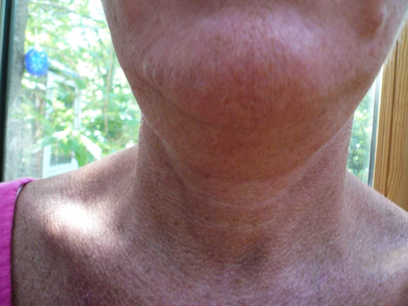 preop Image of best Smartlipo Neck Liposuction