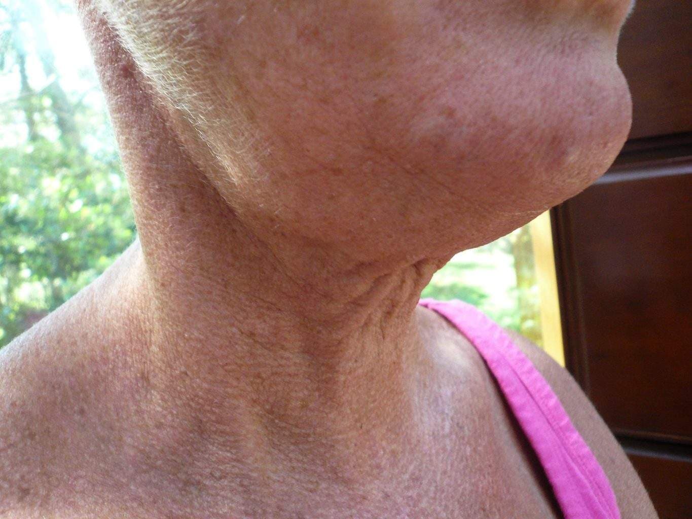 preop Image of best Smartlipo Neck Liposuction