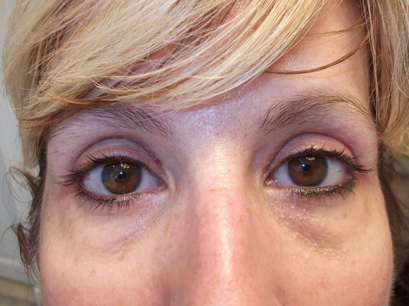 Image of post op Blepharoplasty Eyelid tightening with perfect results and non-visible scar by Best R.I. Plastic Surgeon
