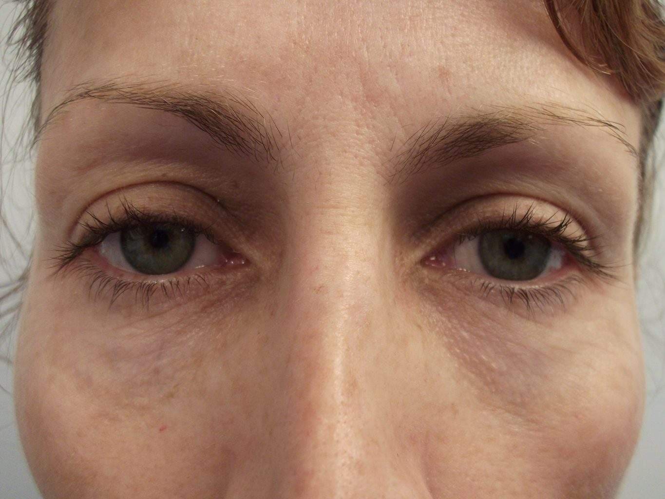 Image of Eyelid Tightening Blepharoplasty Preop by Rhode Island  Plastic Surgery excellence