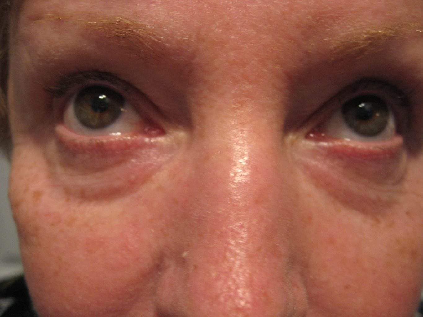 Image of Eyelid Tightening Blepharoplasty Preop by Rhode Island  Plastic Surgery excellence