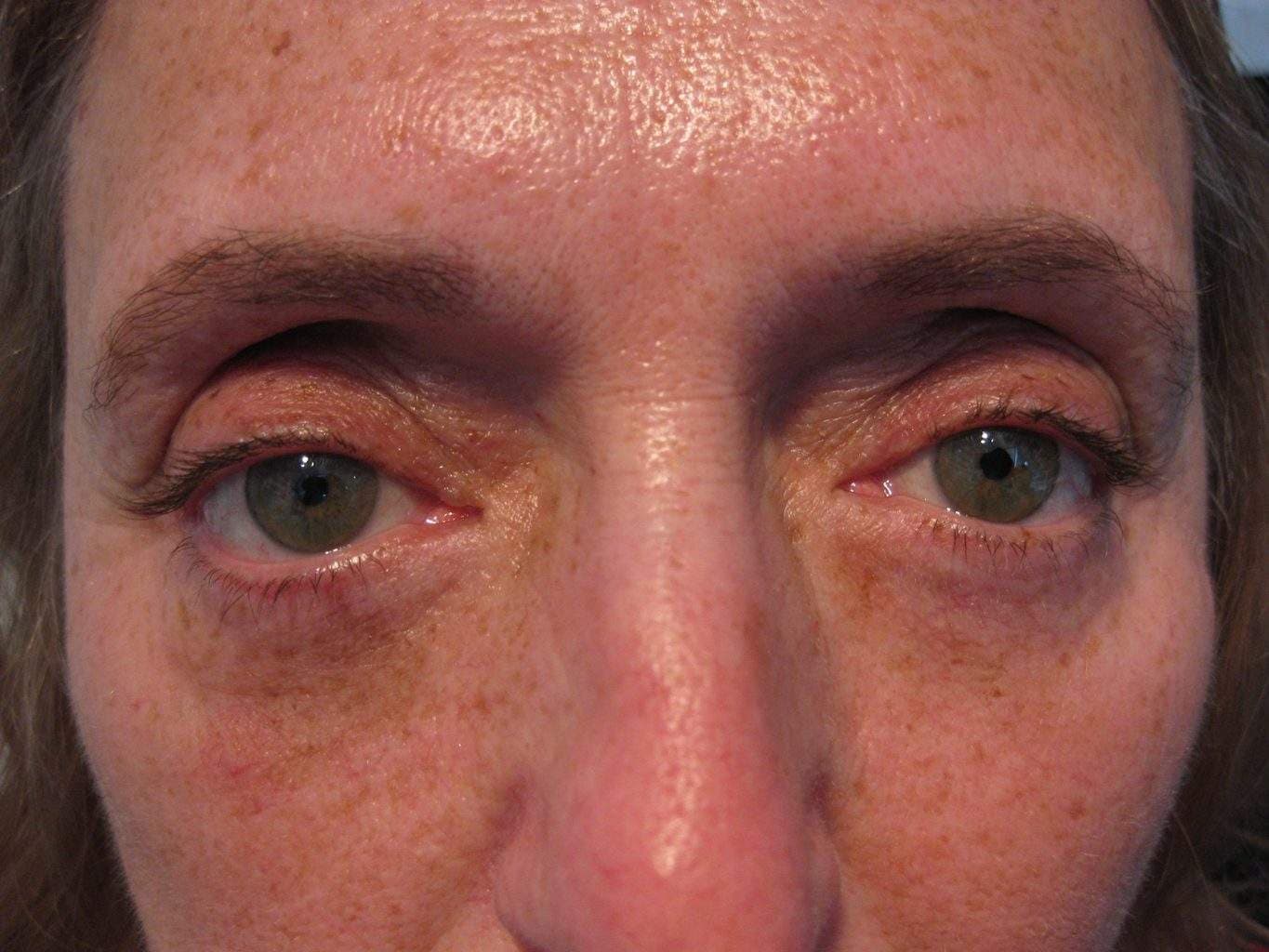 Image of post op Blepharoplasty Eyelid tightening with perfect results and non-visible scar by Best R.I. Plastic Surgeon