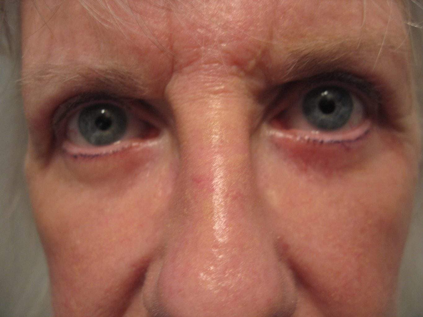 Image of post op Blepharoplasty Eyelid tightening with perfect results and non-visible scar by Best R.I. Plastic Surgeon