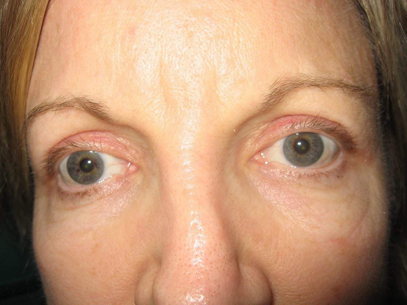 Image of post op Blepharoplasty Eyelid tightening with perfect results and non-visible scar by Best R.I. Plastic Surgeon
