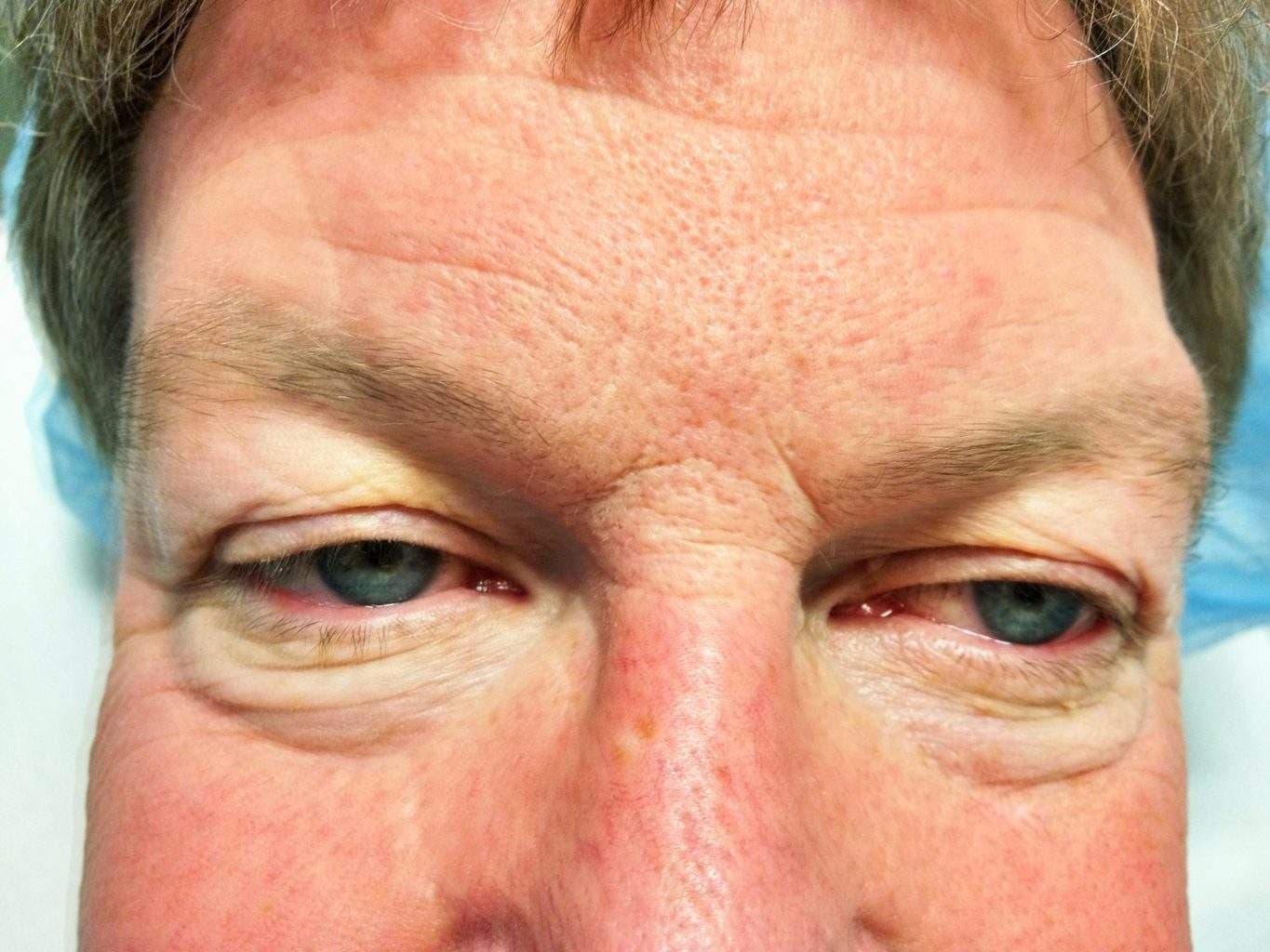 Image of Eyelid Tightening Blepharoplasty Preop by Rhode Island  Plastic Surgery excellence