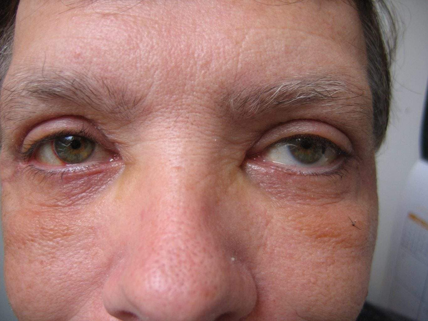 Image of post op Blepharoplasty Eyelid tightening with perfect results and non-visible scar by Best R.I. Plastic Surgeon