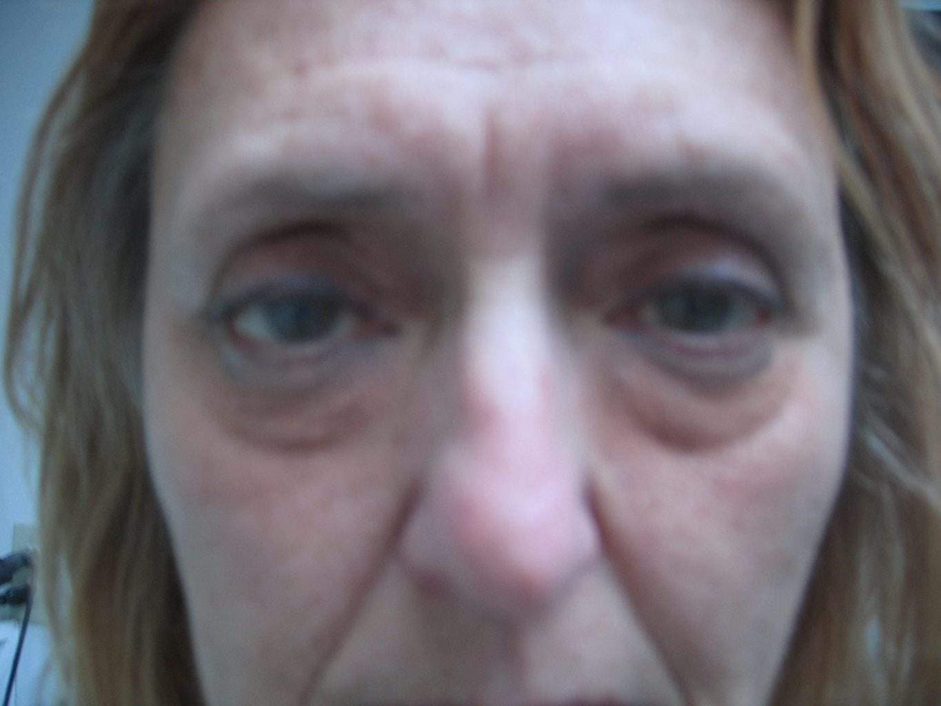 Image of Eyelid Tightening Blepharoplasty Preop by Rhode Island  Plastic Surgery excellence