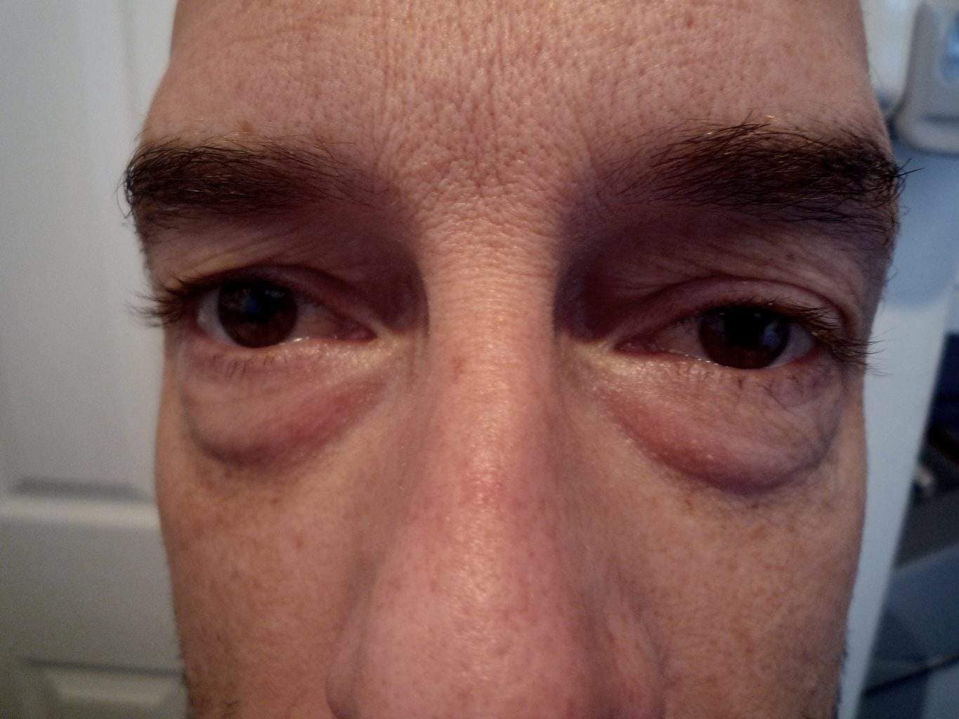 Image of Eyelid Tightening Blepharoplasty Preop by Rhode Island  Plastic Surgery excellence