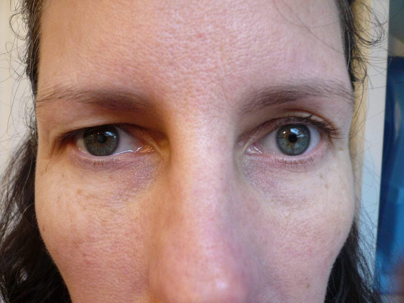Image of Eyelid Tightening Blepharoplasty Preop by Rhode Island  Plastic Surgery excellence
