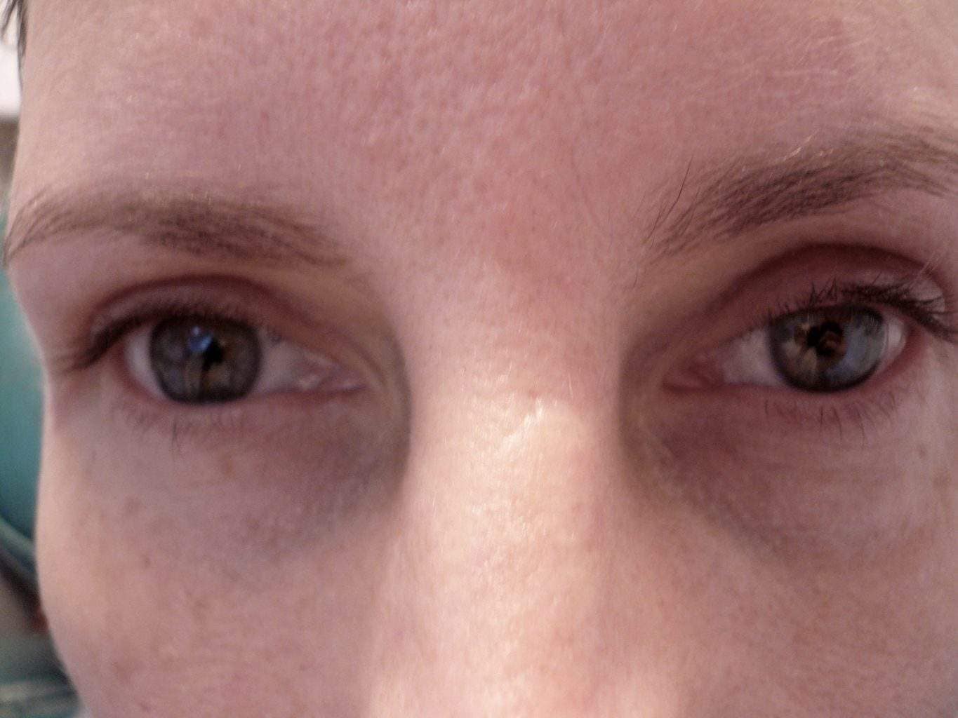 Image of post op Blepharoplasty Eyelid tightening with perfect results and non-visible scar by Best R.I. Plastic Surgeon