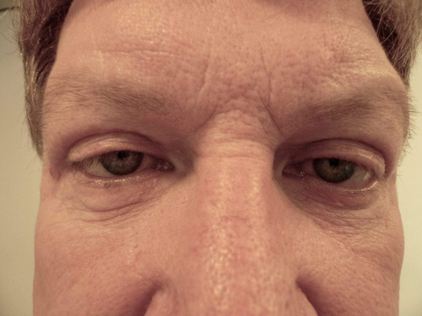 Image of post op Blepharoplasty Eyelid tightening with perfect results and non-visible scar by Best R.I. Plastic Surgeon