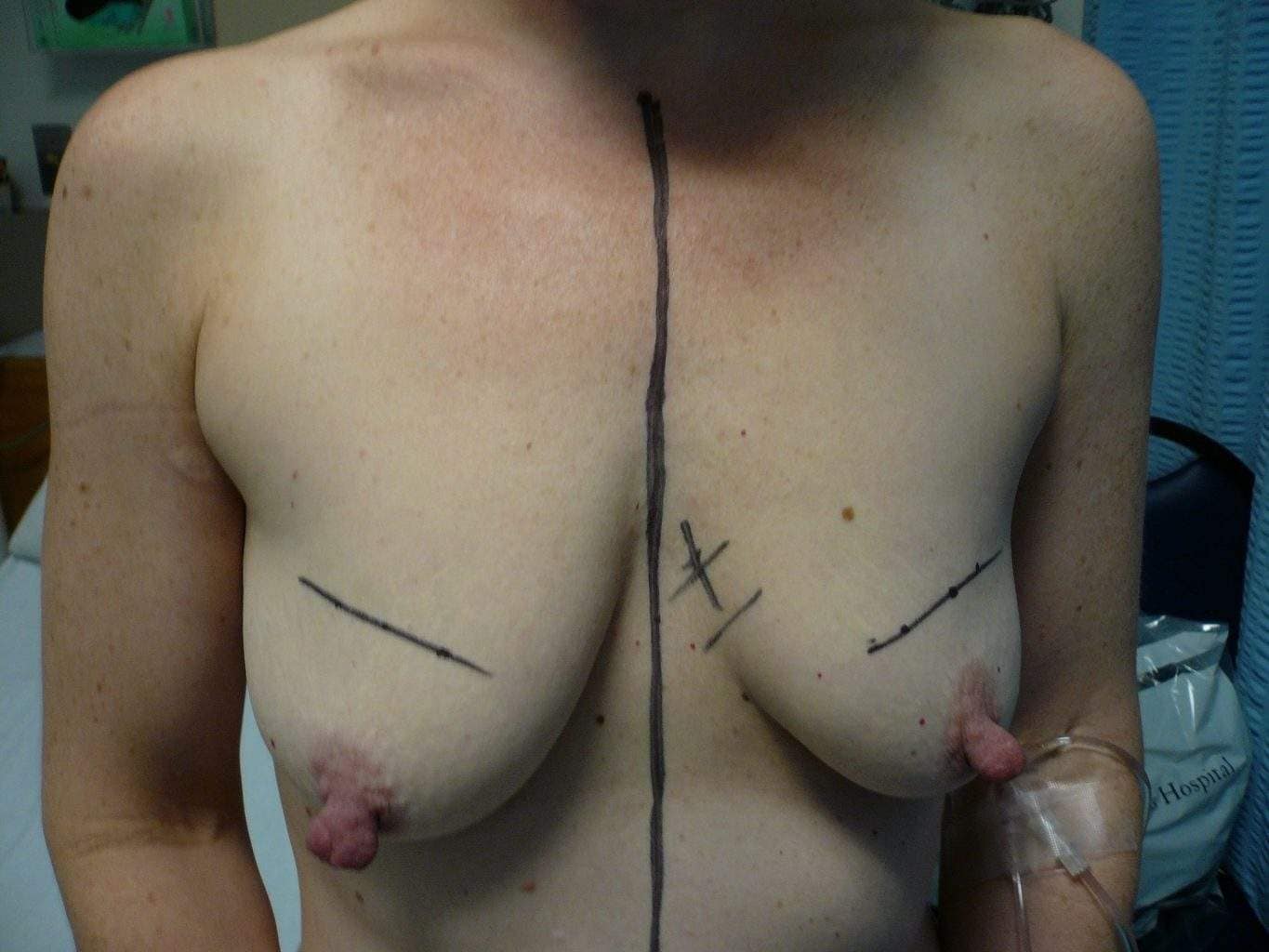 Picture of asymmetric breast with large nipples prior to Mastopexy breast lift surgery with augmentation mammoplasty