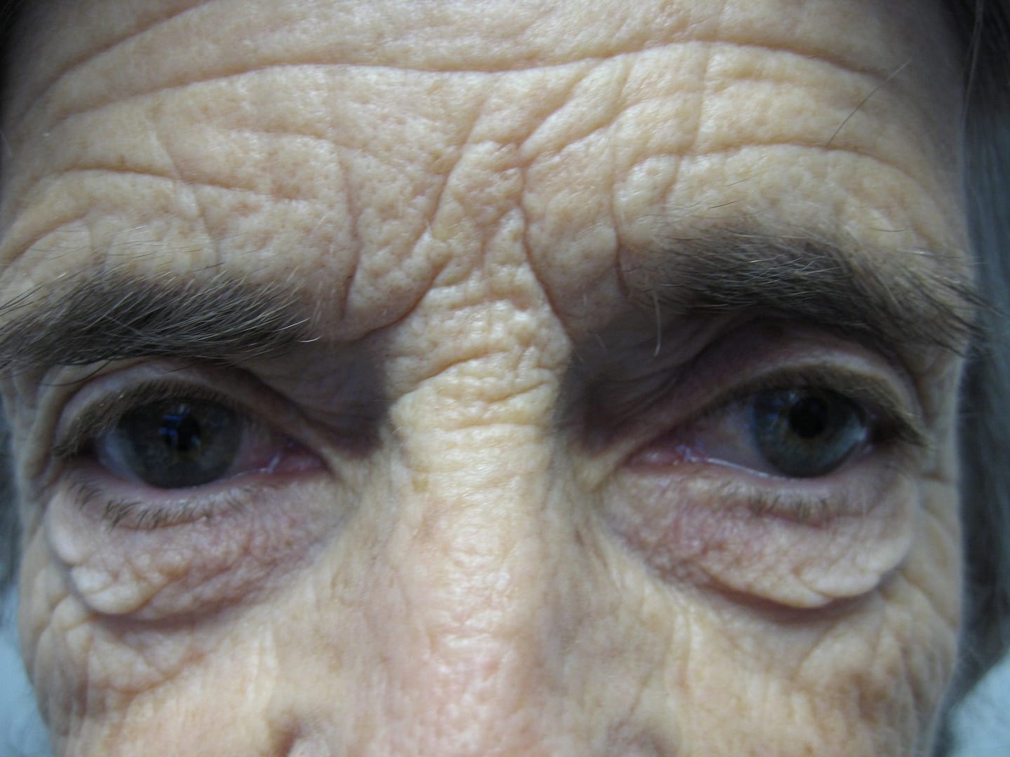 Image of Eyelid Tightening Blepharoplasty Preop by Rhode Island  Plastic Surgery excellence