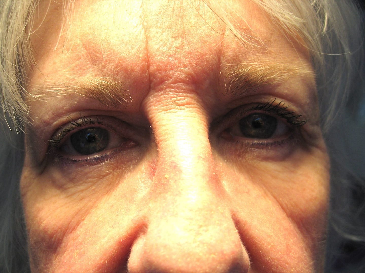 Image of Eyelid Tightening Blepharoplasty Preop by Rhode Island  Plastic Surgery excellence