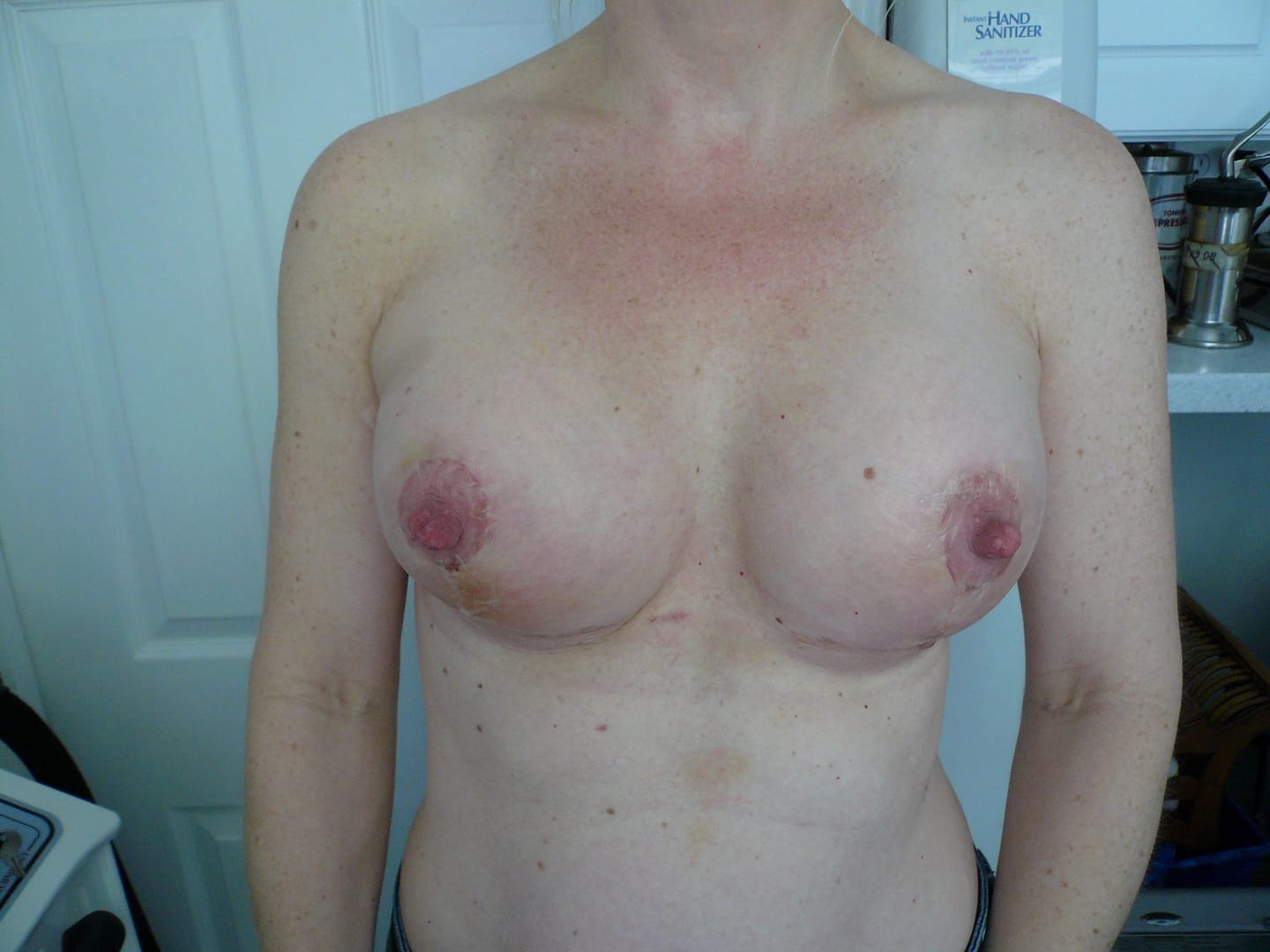 Post operative picture of symmetric breast following mastopexy breast lift with augmentation creating symmetric and nice sized areola and full rounded breast