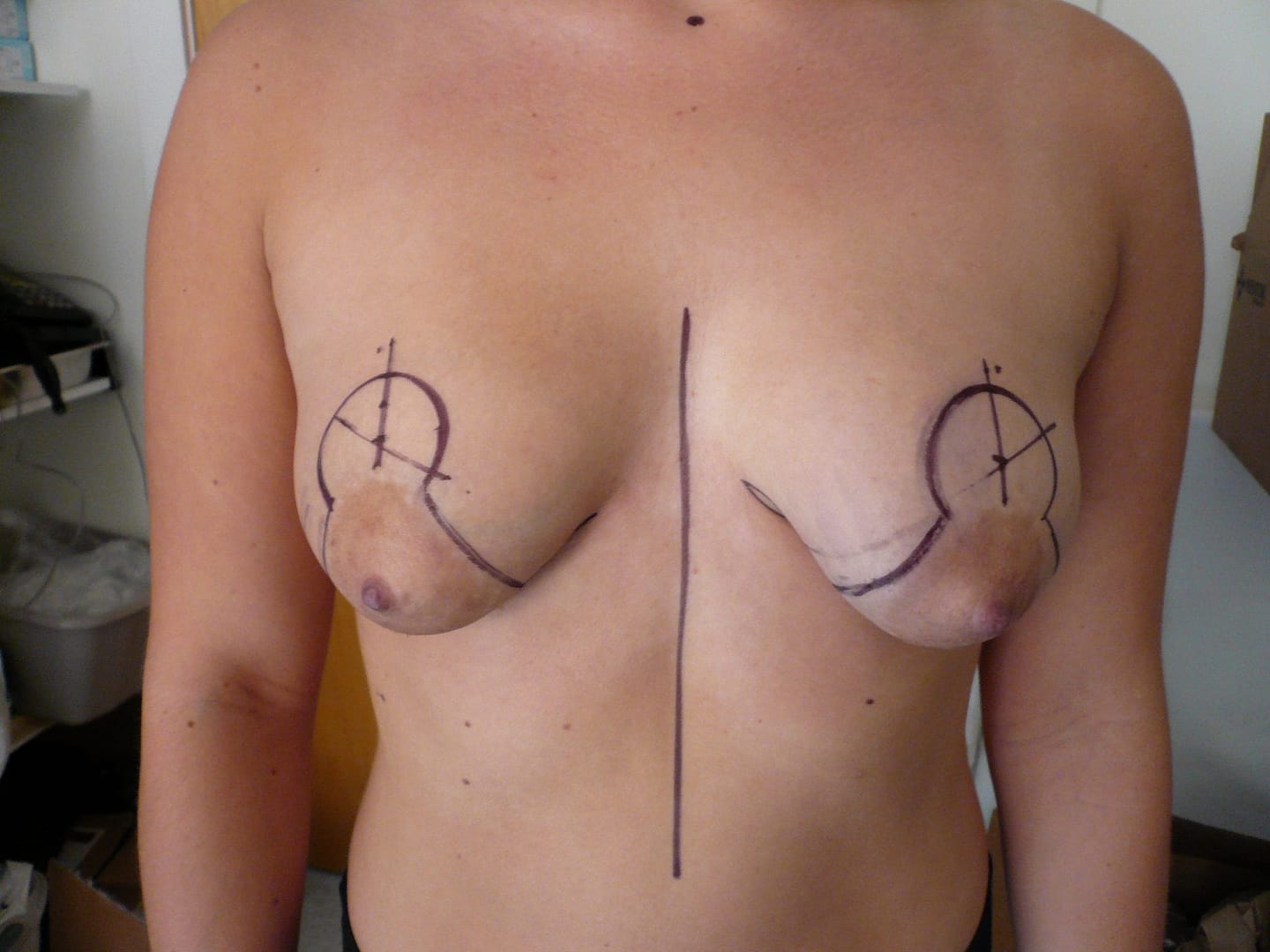 Photo of ptotic pointy breast being treated by Dr. O'Sullivan with Mastopexy Breast Lift Augmentation Implant Pre Op