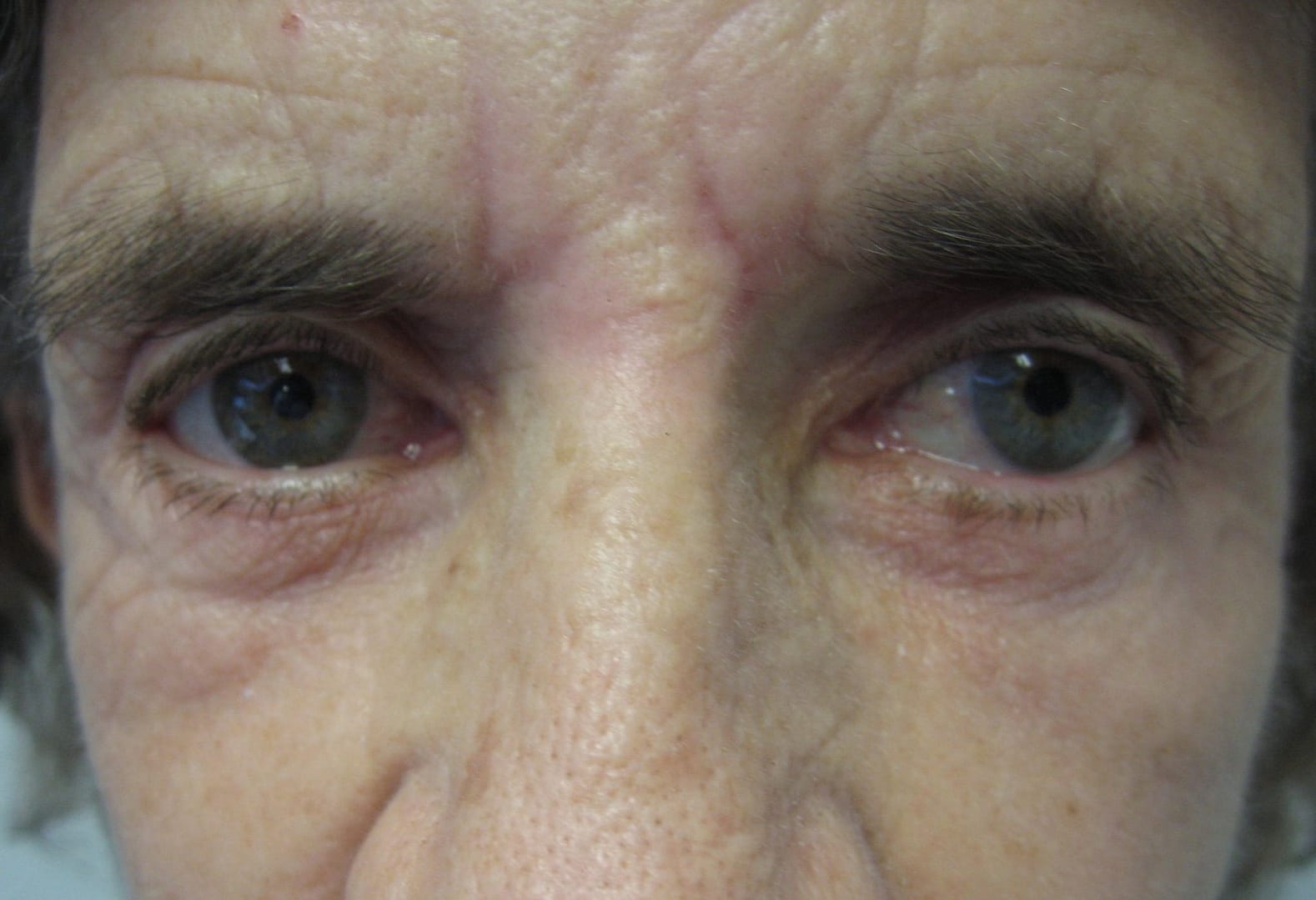 Image of post op Blepharoplasty Eyelid tightening with perfect results and non-visible scar by Best R.I. Plastic Surgeon
