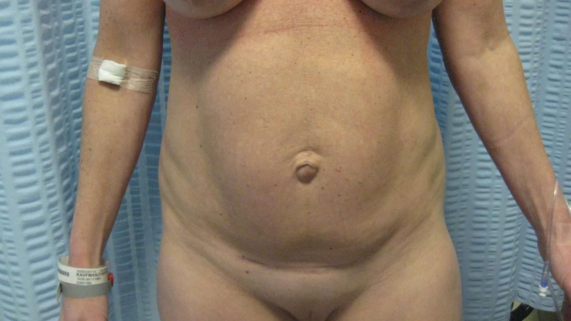 image of preop abdomioplasty tummy tuck mommy make over surgery by Dr. O'Sullivan 