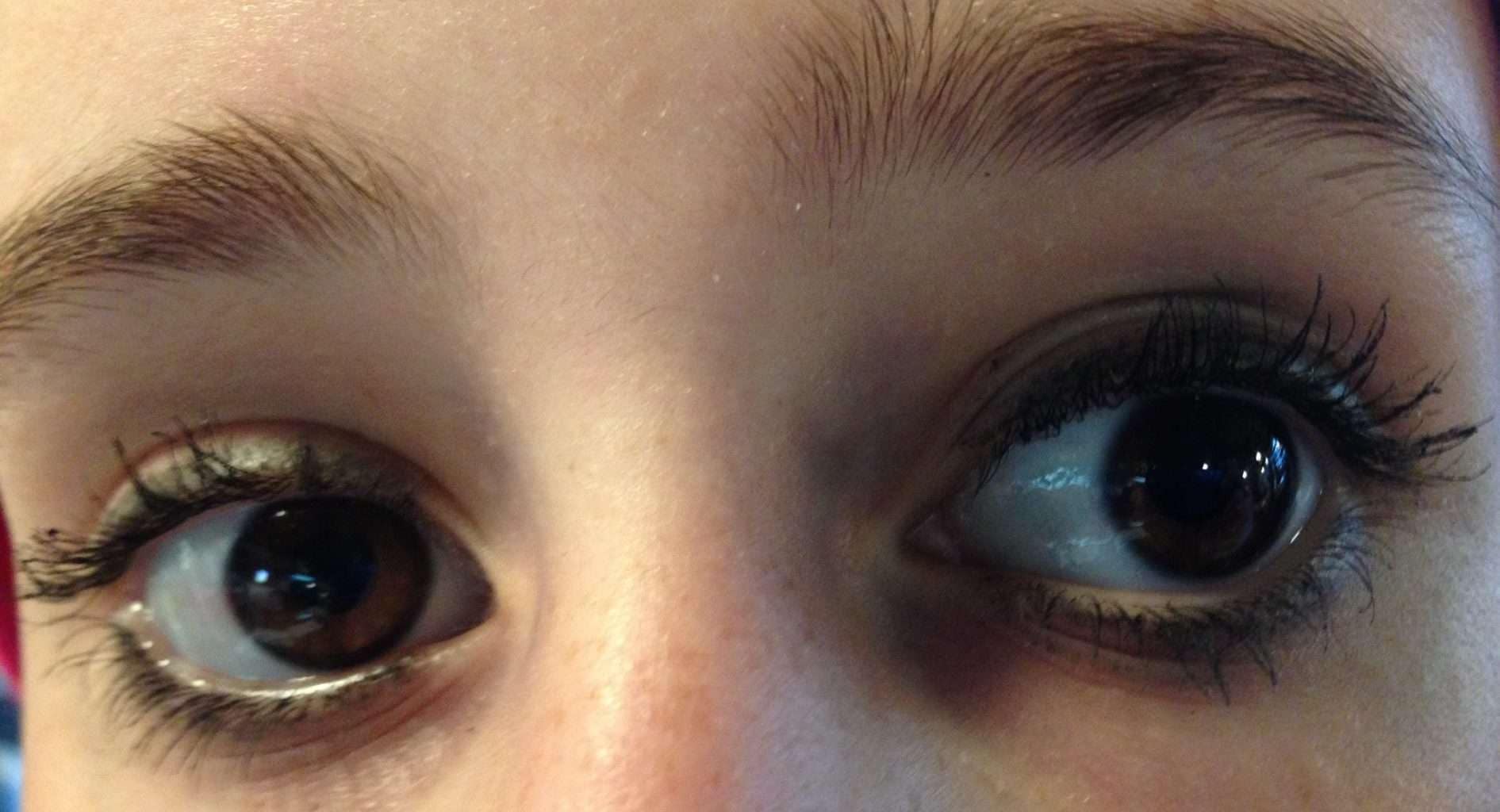 Blepharoplasty ~ Eyelid Tightening