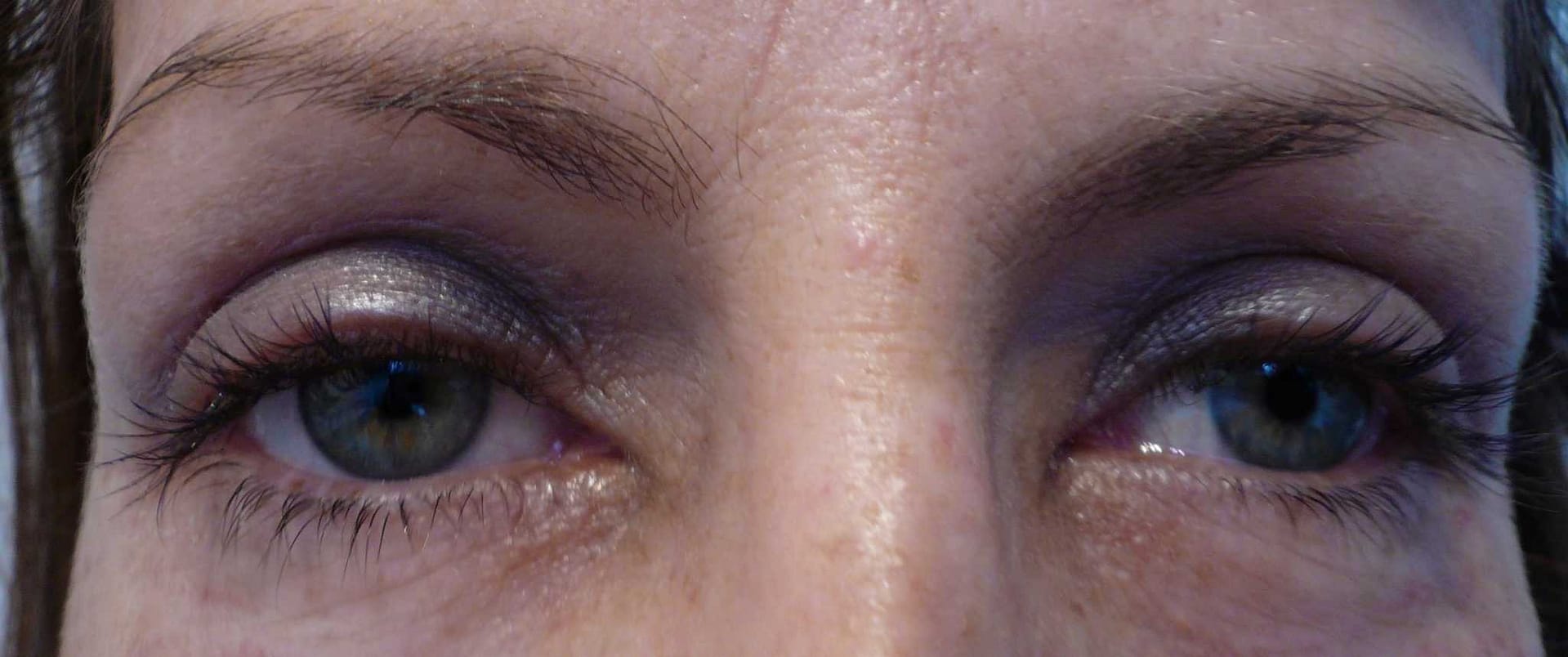 Image of post op Blepharoplasty Eyelid tightening with perfect results and non-visible scar by Best R.I. Plastic Surgeon