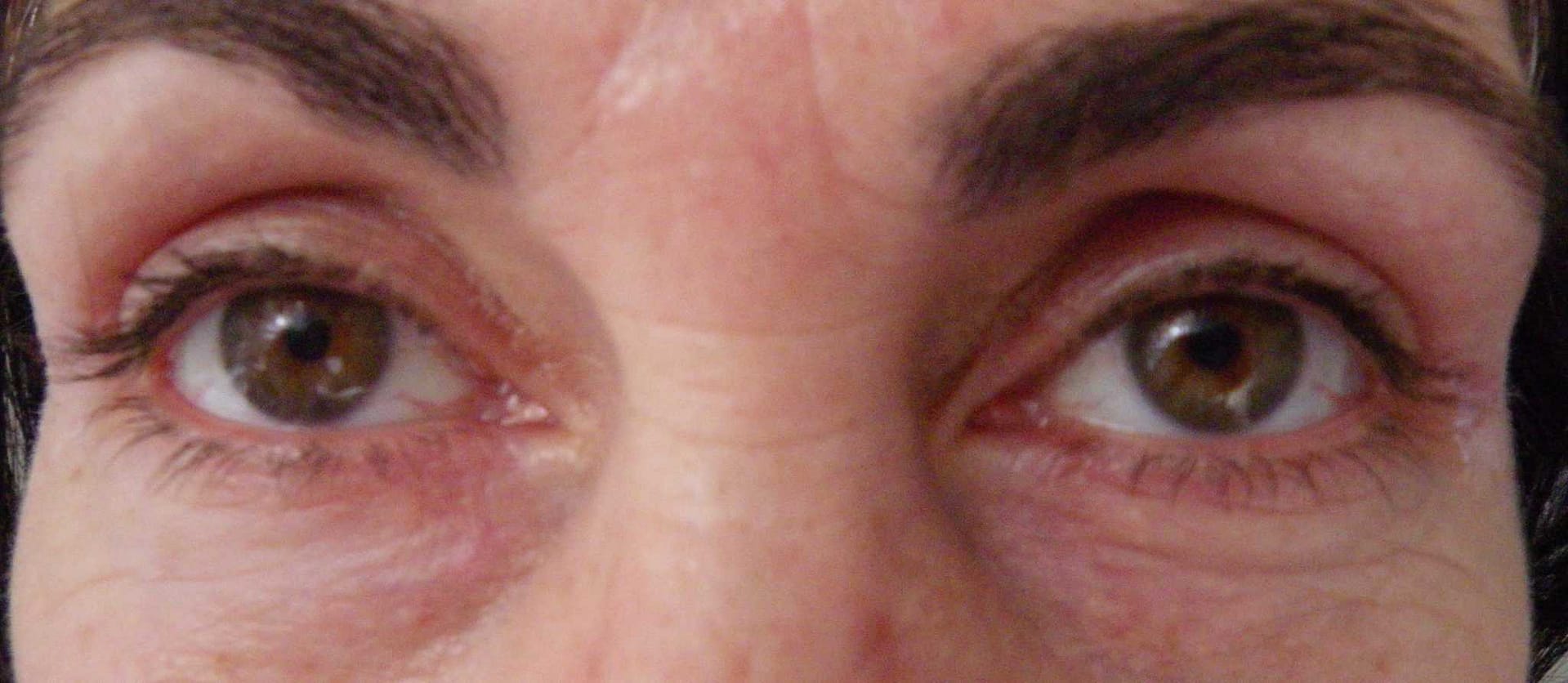 Image of post op Blepharoplasty Eyelid tightening with perfect results and non-visible scar by Best R.I. Plastic Surgeon