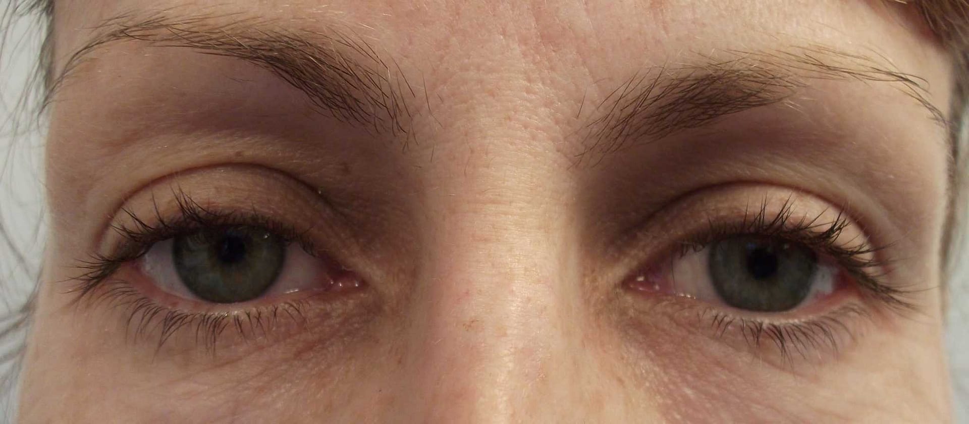 Image of Eyelid Tightening Blepharoplasty Preop by Rhode Island  Plastic Surgery excellence