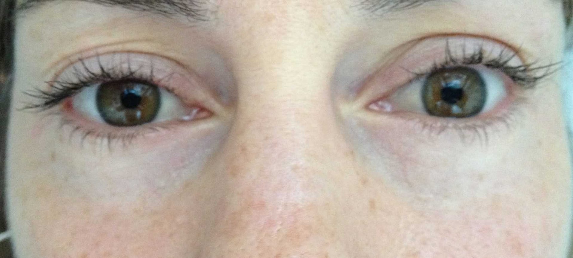Image of post op Blepharoplasty Eyelid tightening with perfect results and non-visible scar by Best R.I. Plastic Surgeon