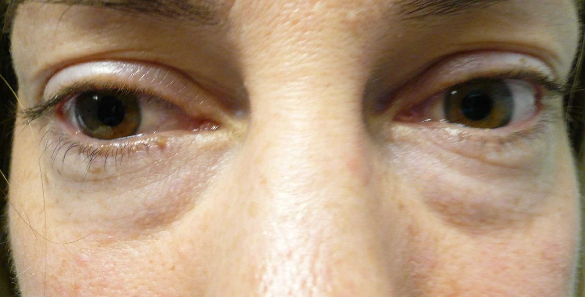 Image of Eyelid Tightening Blepharoplasty Preop by Rhode Island  Plastic Surgery excellence