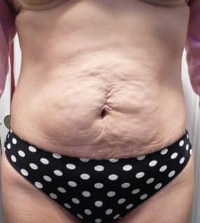 image of preop abdomioplasty tummy tuck mommy make over surgery by Dr. O'Sullivan 