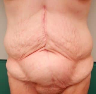 image of preop abdomioplasty tummy tuck mommy make over surgery by Dr. O'Sullivan 