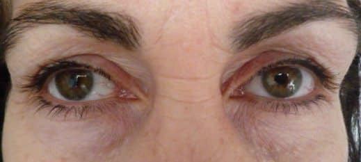 Image of Eyelid Tightening Blepharoplasty Preop by Rhode Island  Plastic Surgery excellence