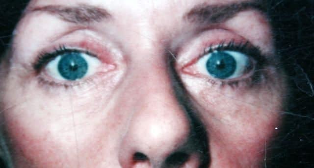 Image of post op Blepharoplasty Eyelid tightening with perfect results and non-visible scar by Best R.I. Plastic Surgeon