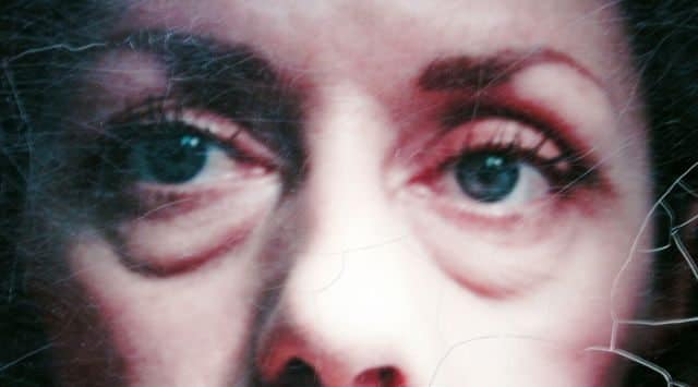 Image of Eyelid Tightening Blepharoplasty Preop by Rhode Island  Plastic Surgery excellence