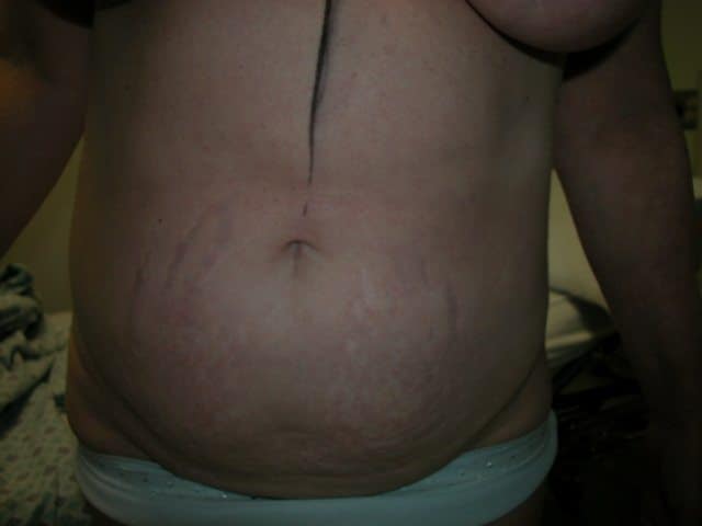 image of preop abdomioplasty tummy tuck mommy make over surgery by Dr. O'Sullivan 
