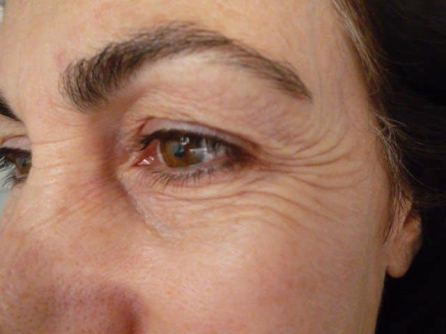 Image of Eyelid Tightening Blepharoplasty Preop by Rhode Island  Plastic Surgery excellence