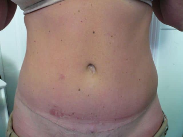image of amazing best contour post abdominoplasty tummy tuck mommy make over surgery 