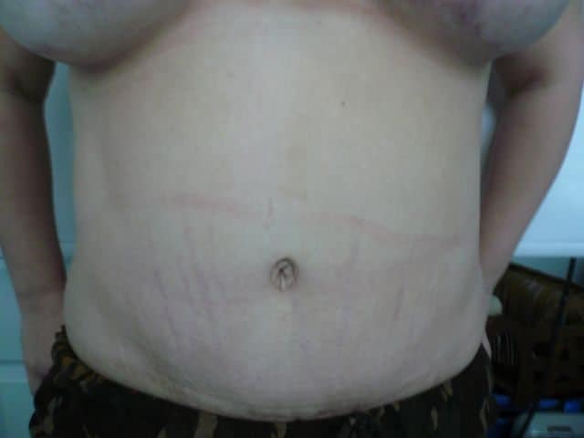 image of amazing best contour post abdominoplasty tummy tuck mommy make over surgery 