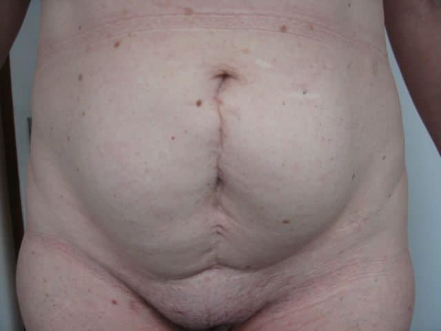 image of preop abdomioplasty tummy tuck mommy make over surgery by Dr. O'Sullivan 