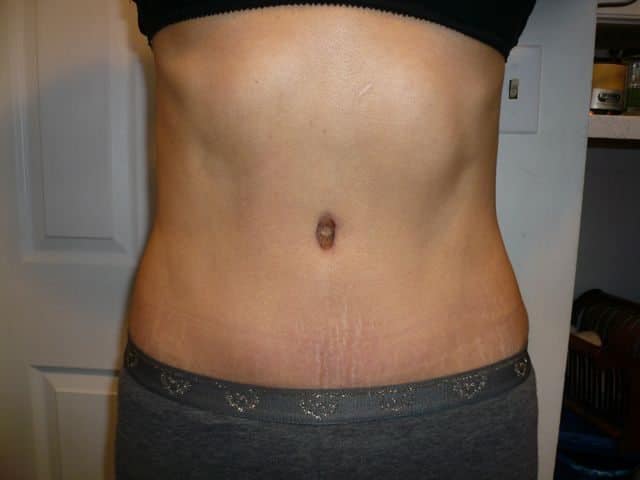 image of amazing best contour post abdominoplasty tummy tuck mommy make over surgery 