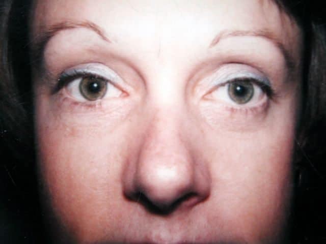 Image of post op Blepharoplasty Eyelid tightening with perfect results and non-visible scar by Best R.I. Plastic Surgeon