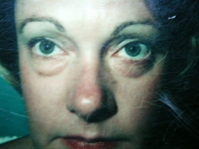 Image of Eyelid Tightening Blepharoplasty Preop by Rhode Island  Plastic Surgery excellence